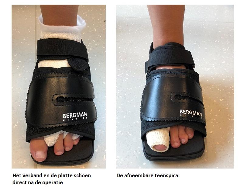 Hallux Valgus Orthopedie Team